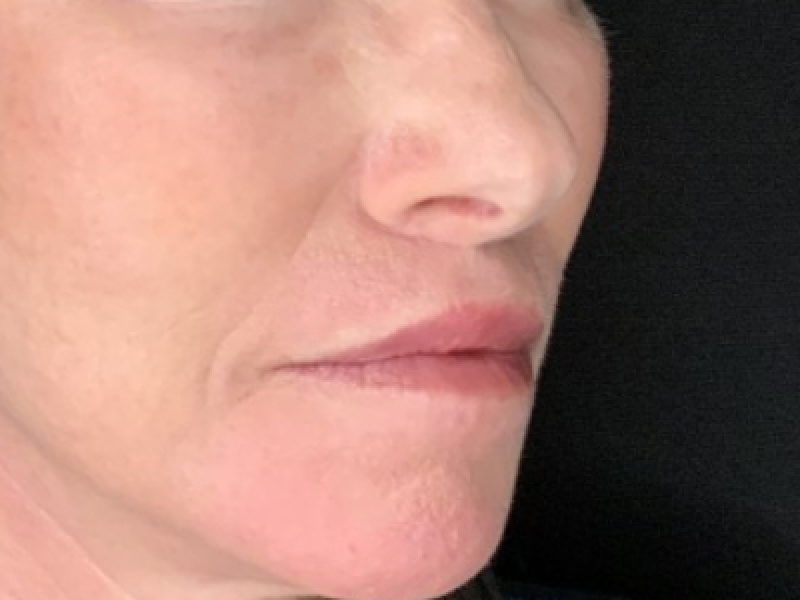 Patient #12585: Resurfacing CO2 Laser with Lip Lift After Image