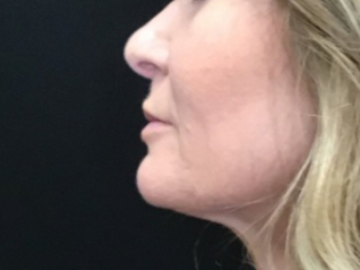 Patient #93804 – Ablative Laser After Image