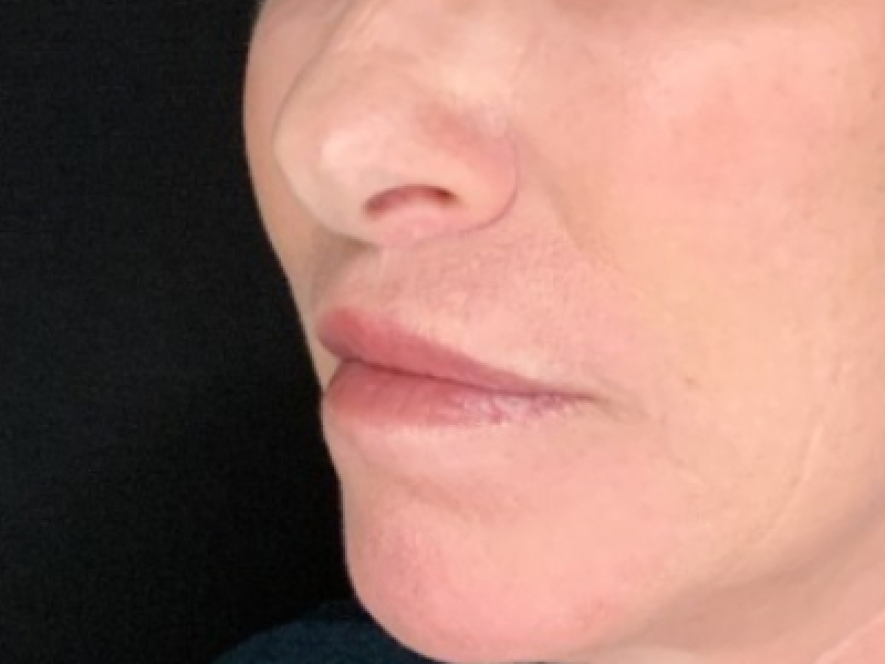 Patient #12585: Resurfacing CO2 Laser with Lip Lift After Image
