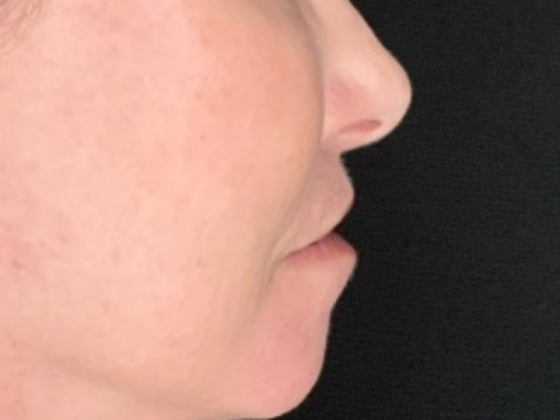 Patient #12585: Resurfacing CO2 Laser with Lip Lift After Image