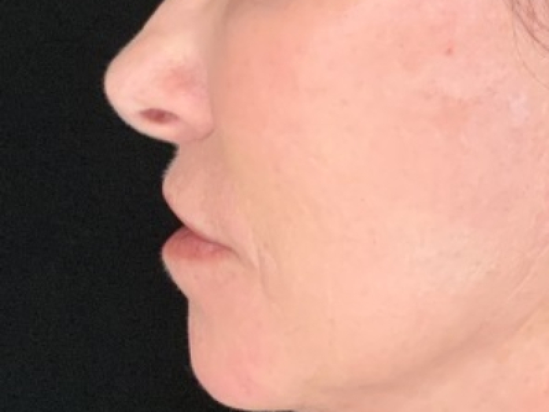 Patient #12585: Resurfacing CO2 Laser with Lip Lift After Image