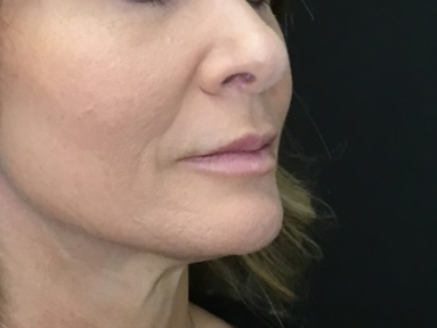 Patient #93804 – Ablative Laser After Image
