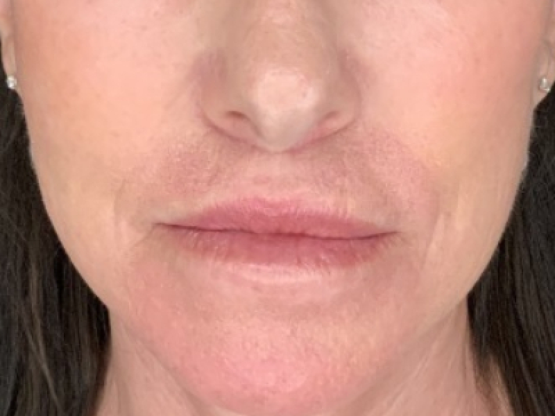 Patient #12585: Resurfacing CO2 Laser with Lip Lift After Image