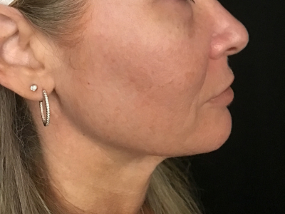 Patient #93804 – Ablative Laser Before Image