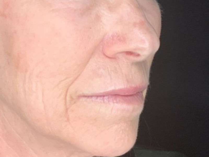 Patient #12585: Resurfacing CO2 Laser with Lip Lift Before Image