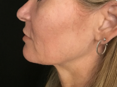 Patient #93804 – Ablative Laser Before Image