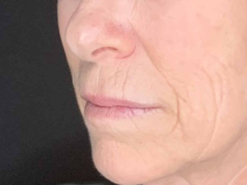 Patient #12585: Resurfacing CO2 Laser with Lip Lift Before Image
