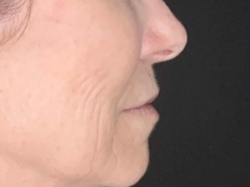 Patient #12585: Resurfacing CO2 Laser with Lip Lift Before Image