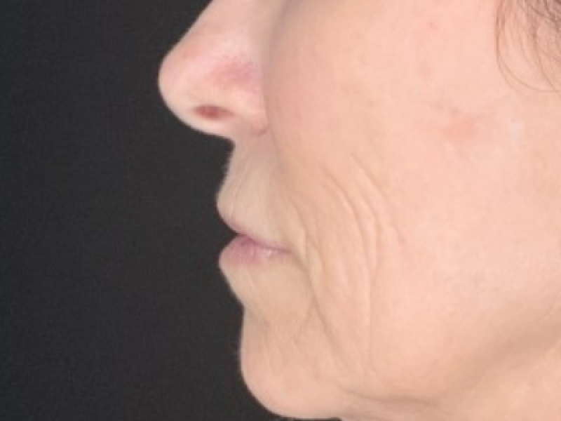 Patient #12585: Resurfacing CO2 Laser with Lip Lift Before Image