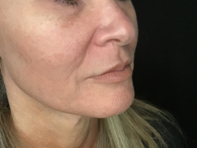 Patient #93804 – Ablative Laser Before Image