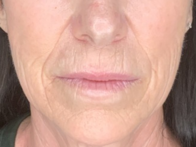 Patient #12585: Resurfacing CO2 Laser with Lip Lift Before Image
