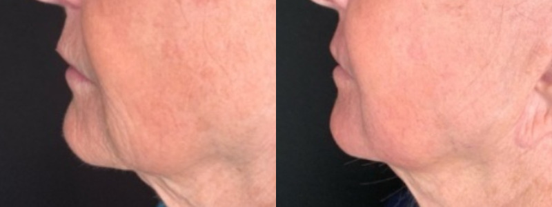 Patient #45320: Resurfacing Combine Image