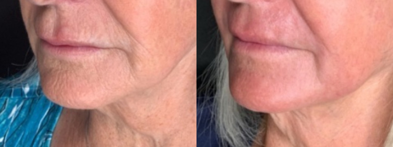 Patient #45320: Resurfacing Combine Image