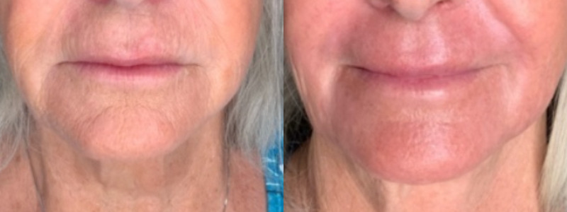 Patient #45320: Resurfacing Combine Image