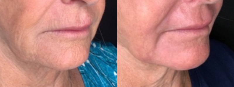 Patient #45320: Resurfacing Combine Image