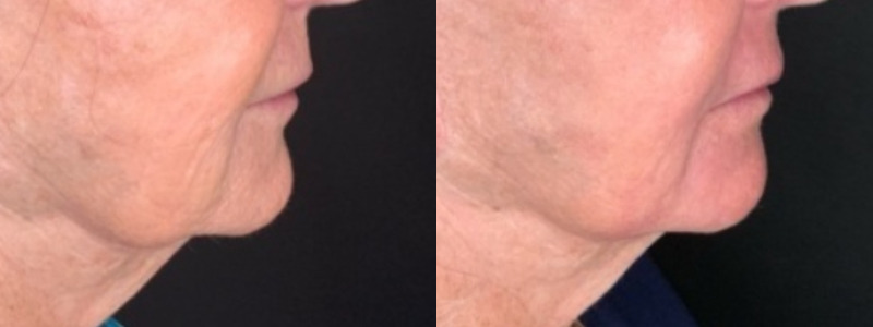 Patient #45320: Resurfacing Combine Image