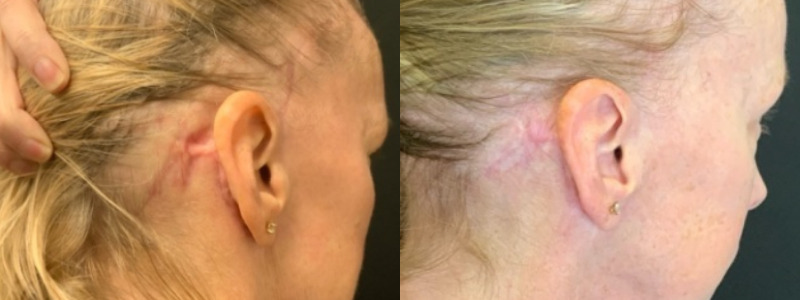 Patient #54697: CO2 Laser Combine Image