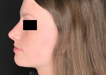 Patient #78452: Rhinoplasty After Image