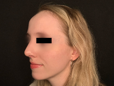 Patient #96589: Rhinoplasty After Image