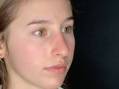 Patient #45695: Rhinoplasty After Image