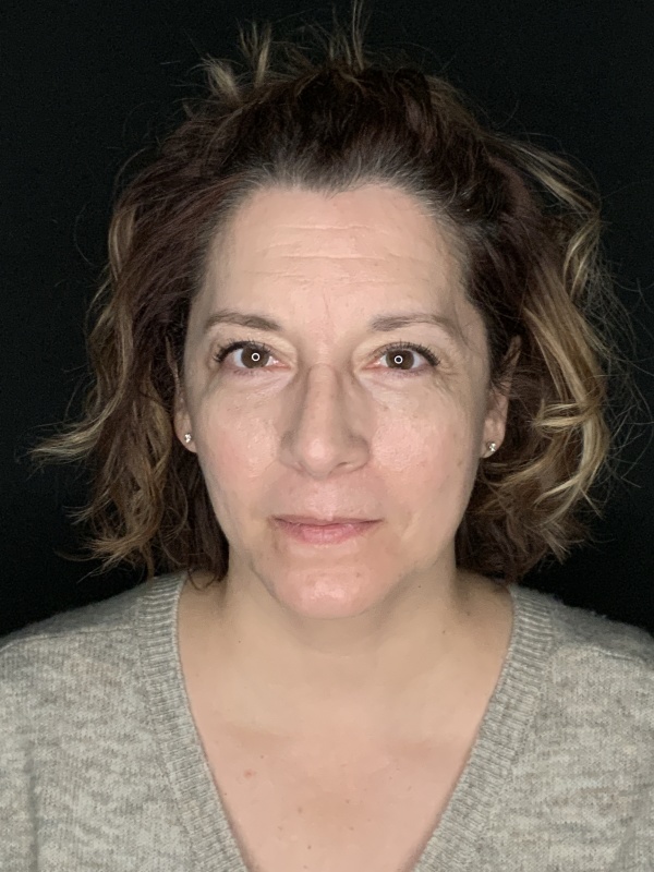Patient #86595: Rhinoplasty & Chin Augmentation After Image