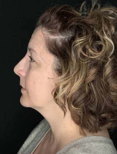 Patient #86595: Rhinoplasty & Chin Augmentation After Image