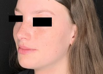 Patient #78452: Rhinoplasty After Image