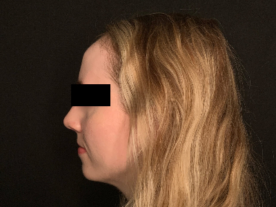 Patient #96589: Rhinoplasty After Image