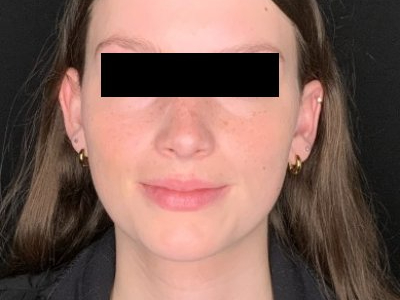 Patient #78452: Rhinoplasty After Image