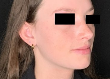 Patient #78452: Rhinoplasty After Image