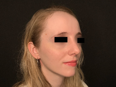 Patient #96589: Rhinoplasty After Image