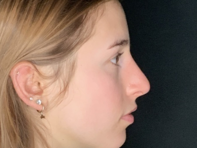 Patient #45695: Rhinoplasty After Image