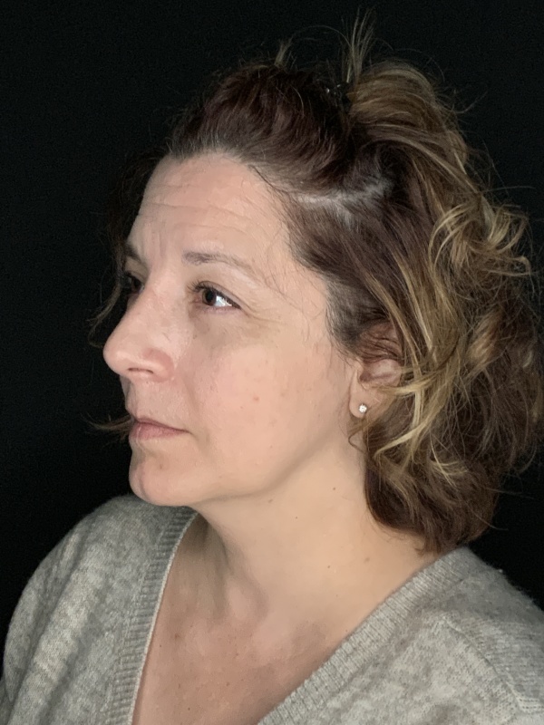 Patient #86595: Rhinoplasty & Chin Augmentation After Image