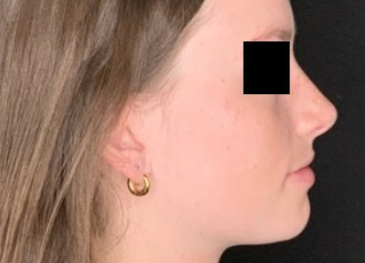 Patient #78452: Rhinoplasty After Image