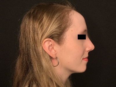 Patient #96589: Rhinoplasty After Image