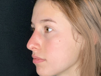 Patient #45695: Rhinoplasty After Image