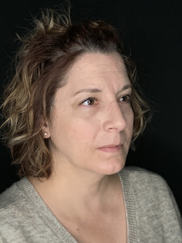 Patient #86595: Rhinoplasty & Chin Augmentation After Image