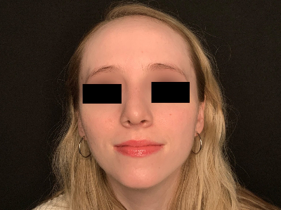 Patient #96589: Rhinoplasty After Image