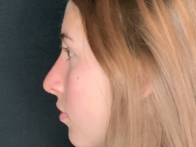 Patient #45695: Rhinoplasty After Image