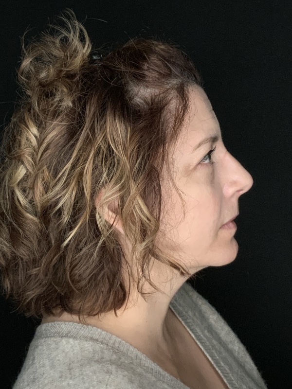 Patient #86595: Rhinoplasty & Chin Augmentation After Image