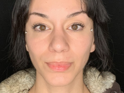 Patient #36974: Rhinoplasty After Image