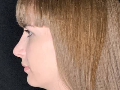 Patient #69547: Rhinoplasty After Image