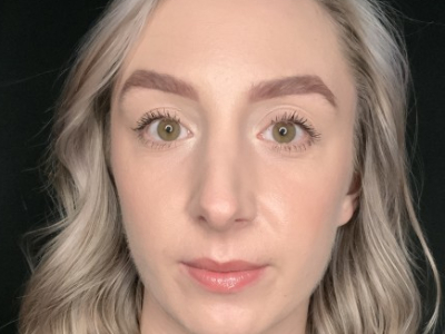 Patient #22669: Rhinoplasty After Image