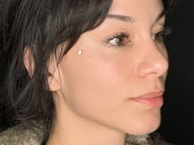Patient #36974: Rhinoplasty After Image