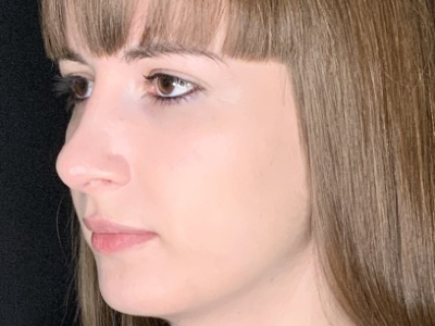 Patient #69547: Rhinoplasty After Image