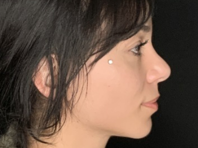 Patient #36974: Rhinoplasty After Image