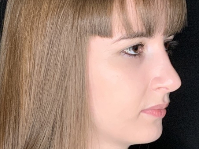 Patient #69547: Rhinoplasty After Image