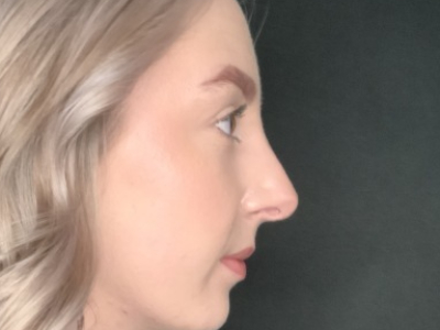 Patient #22669: Rhinoplasty After Image