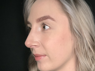 Patient #22669: Rhinoplasty After Image