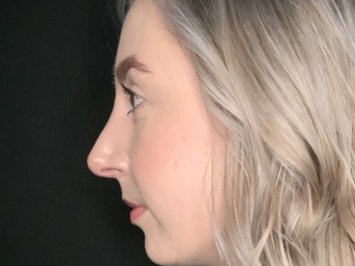 Patient #22669: Rhinoplasty After Image